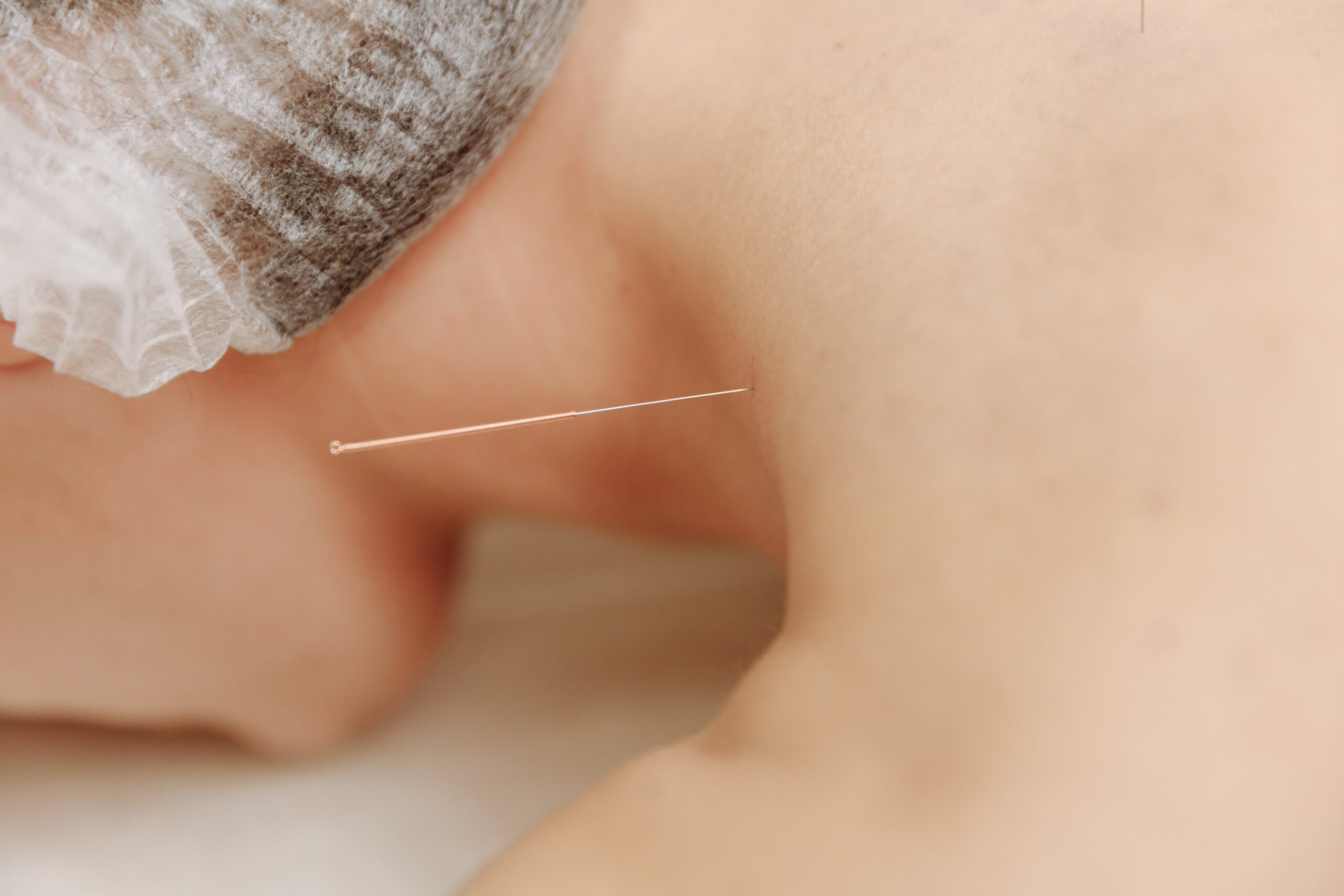 Acupunctura este ideala pentru cei care lucreaza in corporatii
